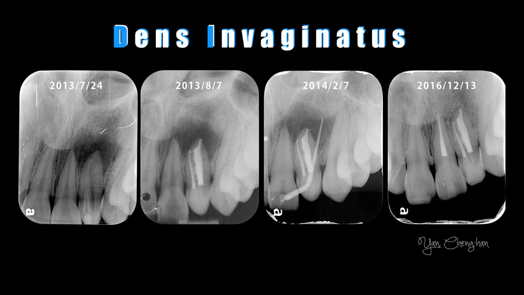 Dens-invaginatus-001