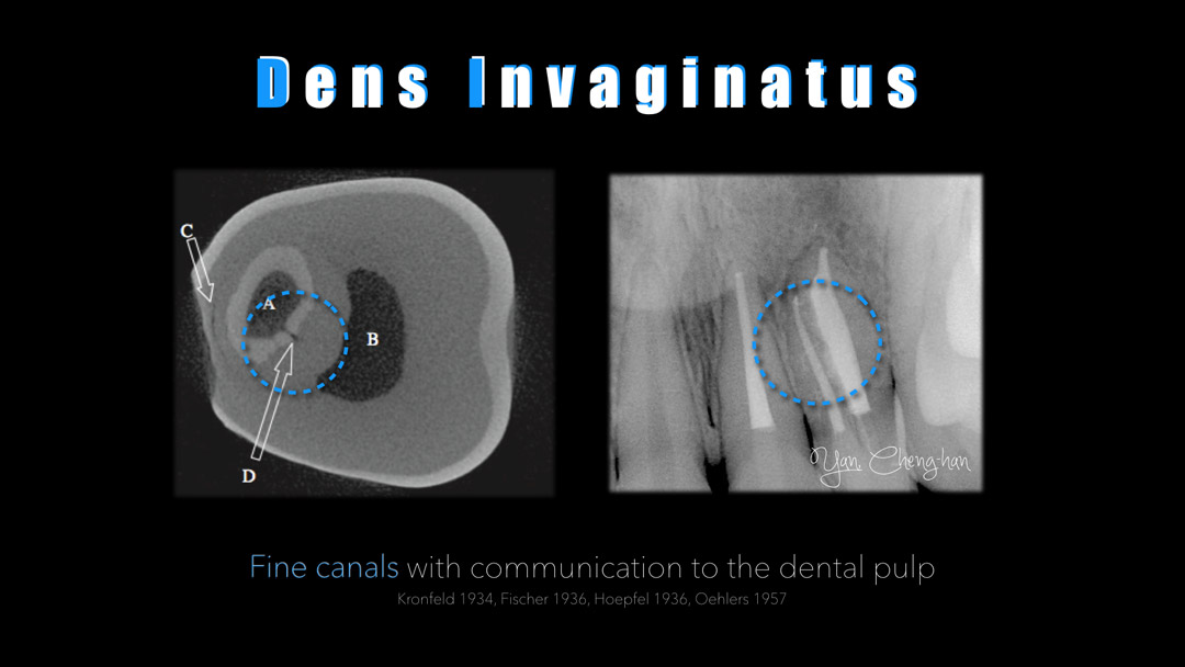 Dens-invaginatus002